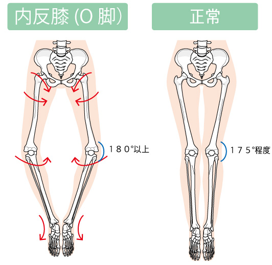 O脚な脚と正常な脚 O脚な脚と正常な脚