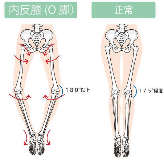 O脚な脚と正常な脚