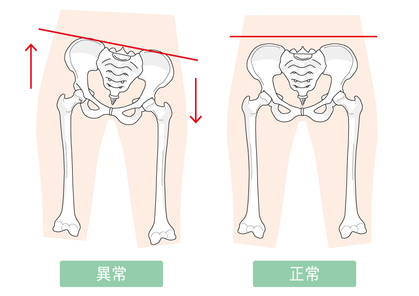 骨盤の正常な状態と歪んだ状態の図 骨盤の正常な状態と歪んだ状態の図